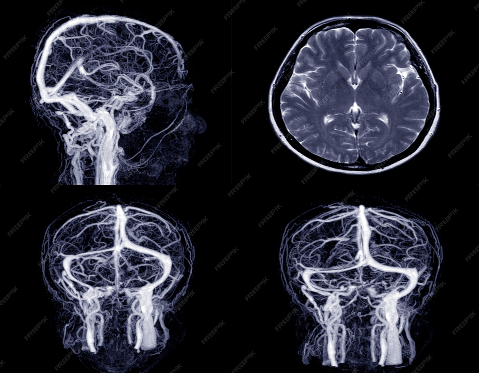 Magnetic Resonance Venography Brain