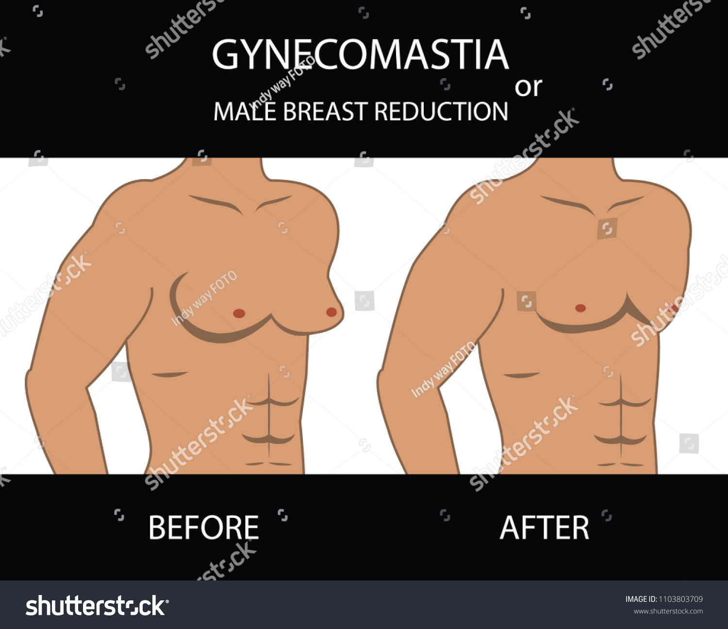Male Breast Reduction