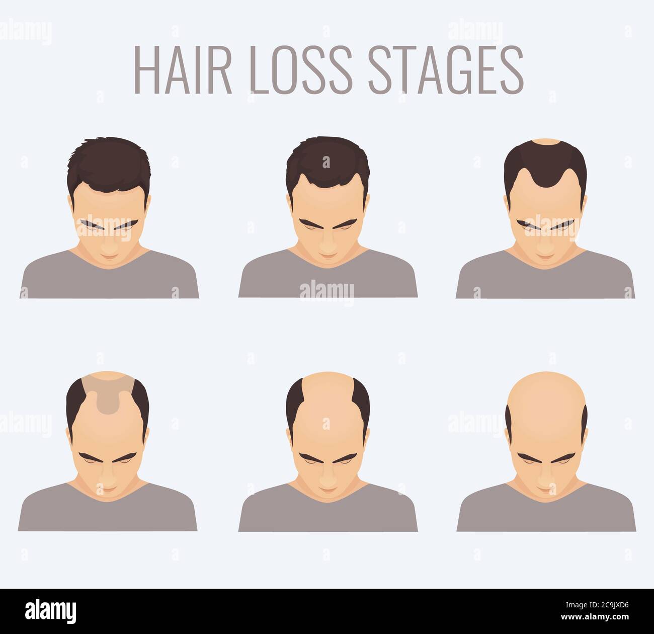 Male Pattern Baldness Stages