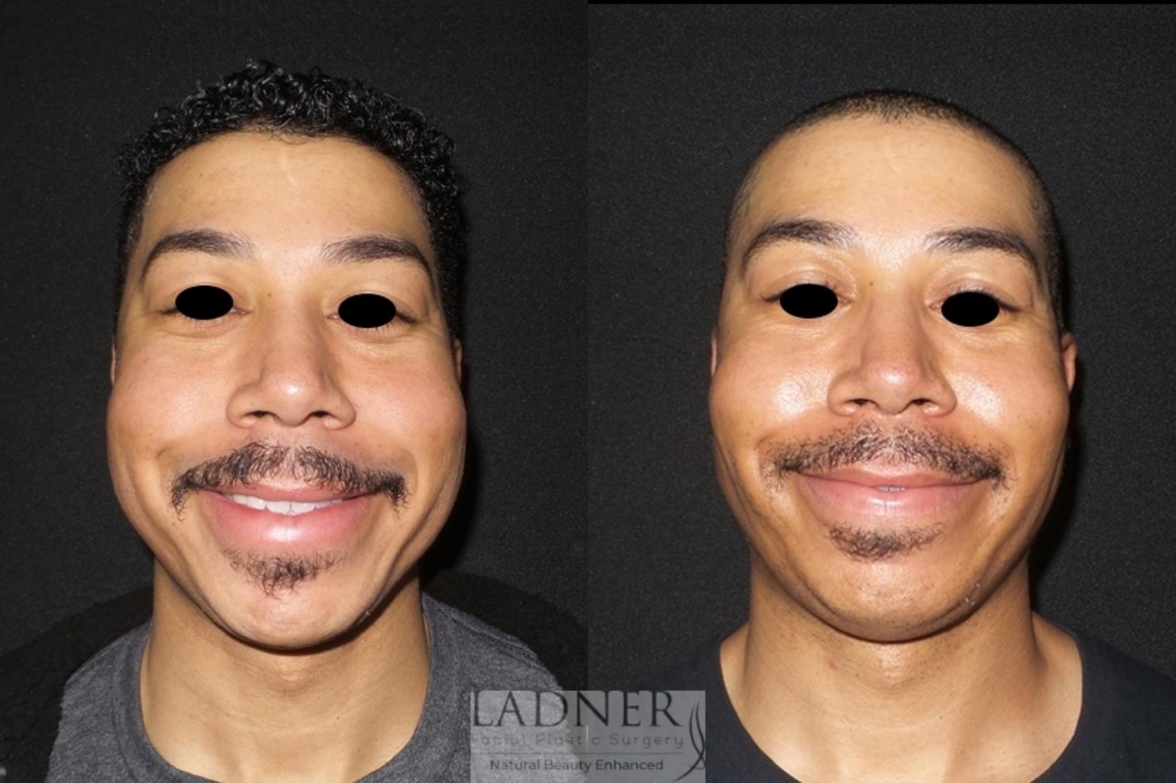 Male Plastic Surgery Face