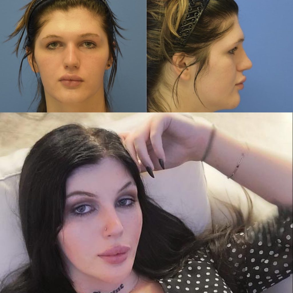 Male To Female Face Surgery