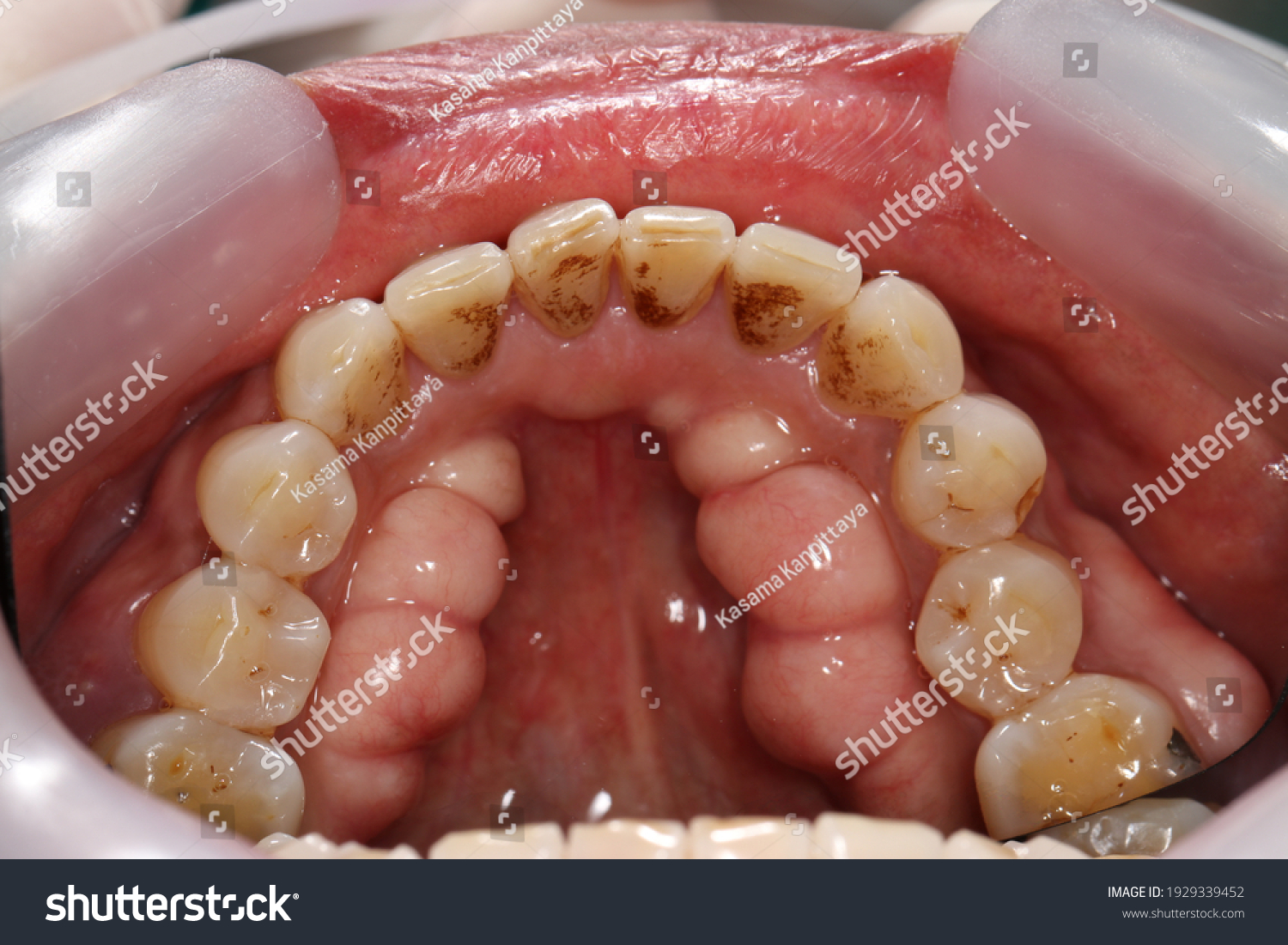 Mandibular Tori Pictures