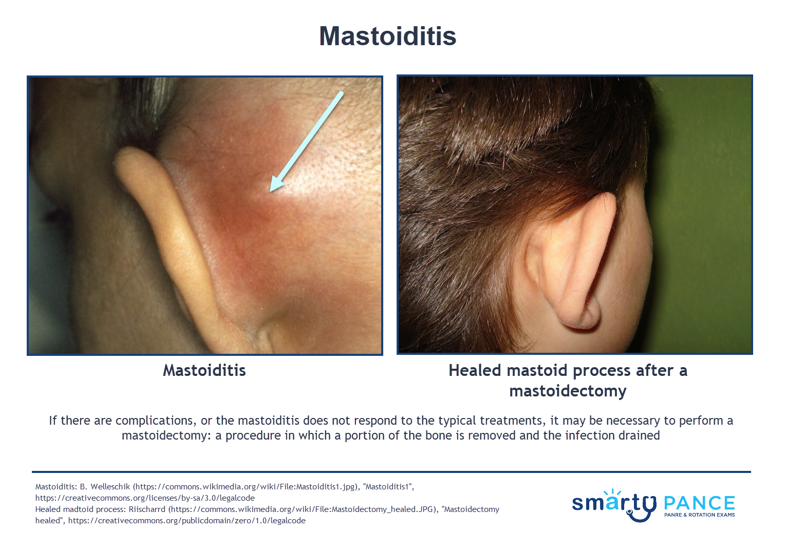 Mastoiditis Symptoms Adults