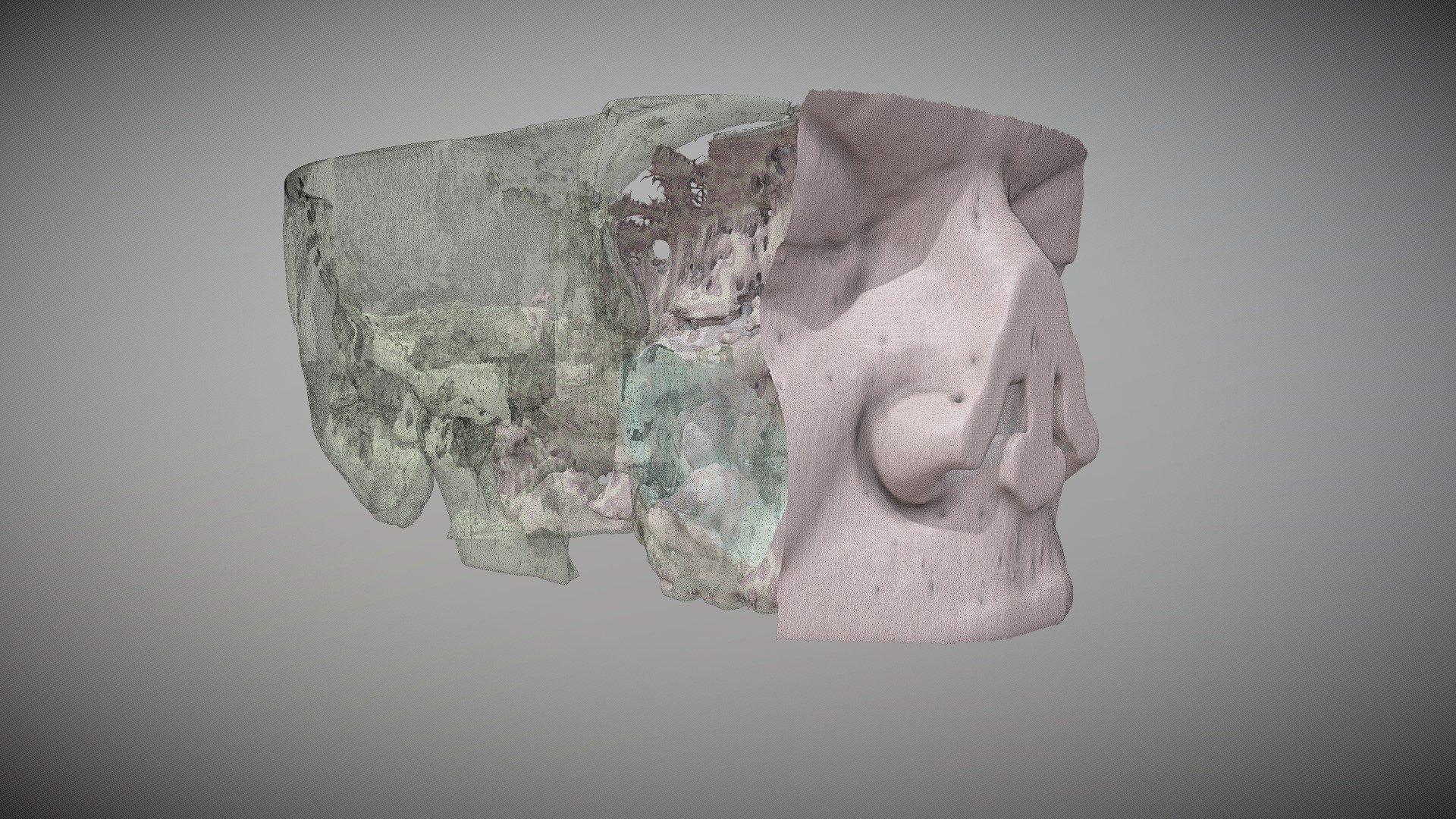 Maxillary Sinus Cyst