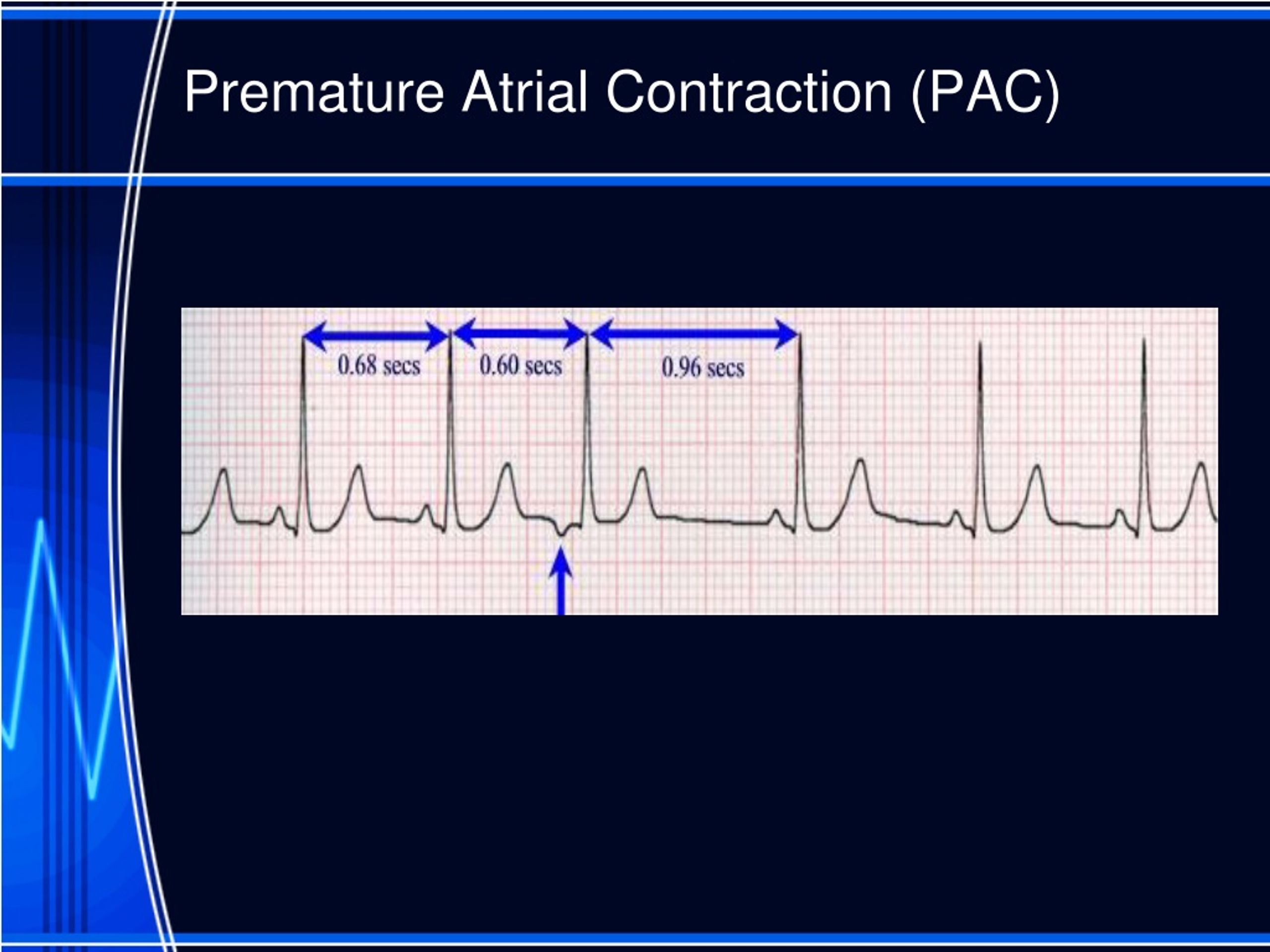 Meaning Of Pac In Medical