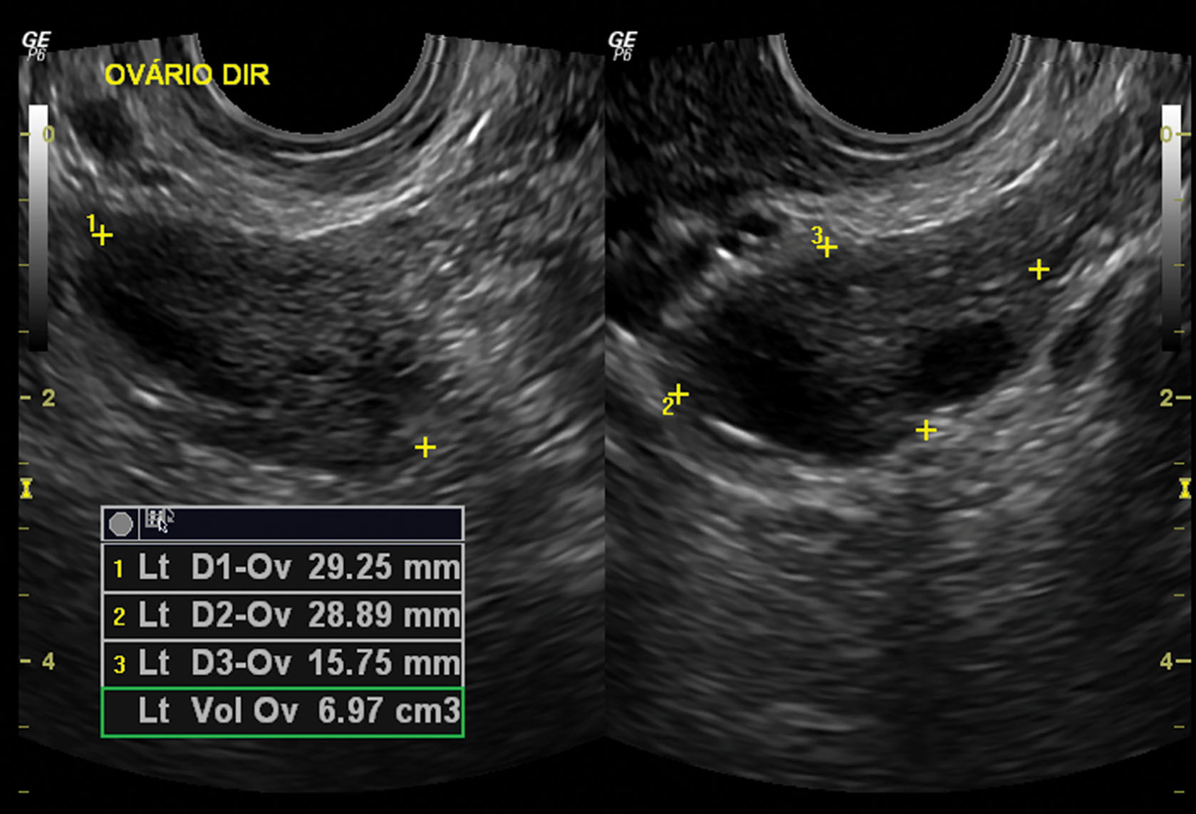Measurement Of Ovary