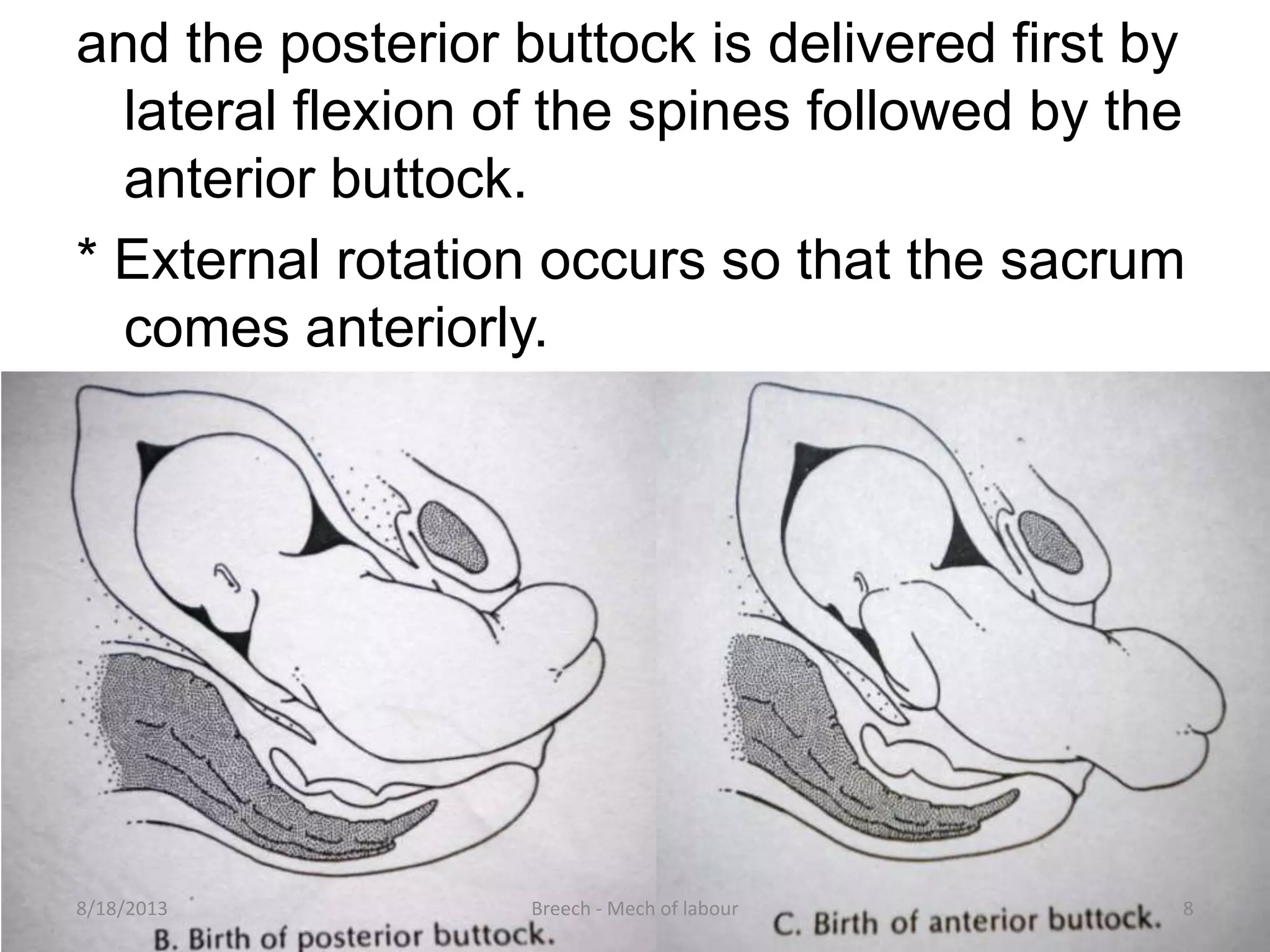 Mechanism Of Breech Presentation
