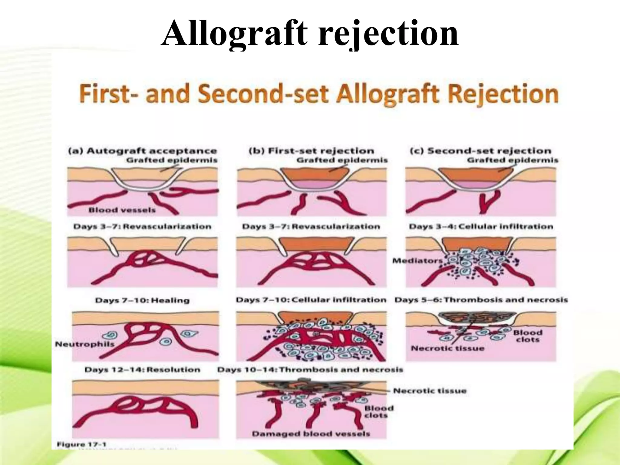 Mechanism Of Graft Rejection
