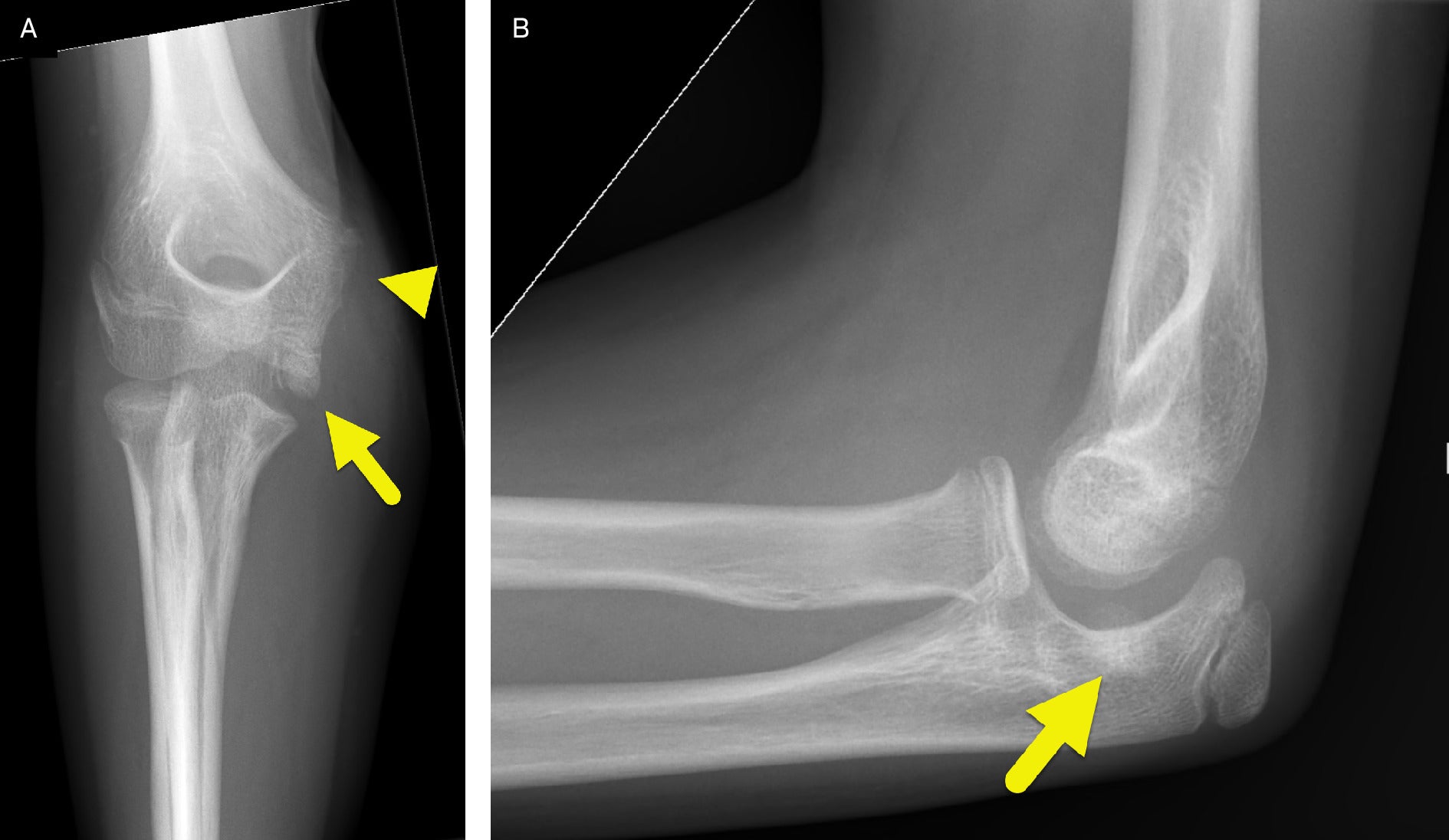 Medial Epicondyle Fracture