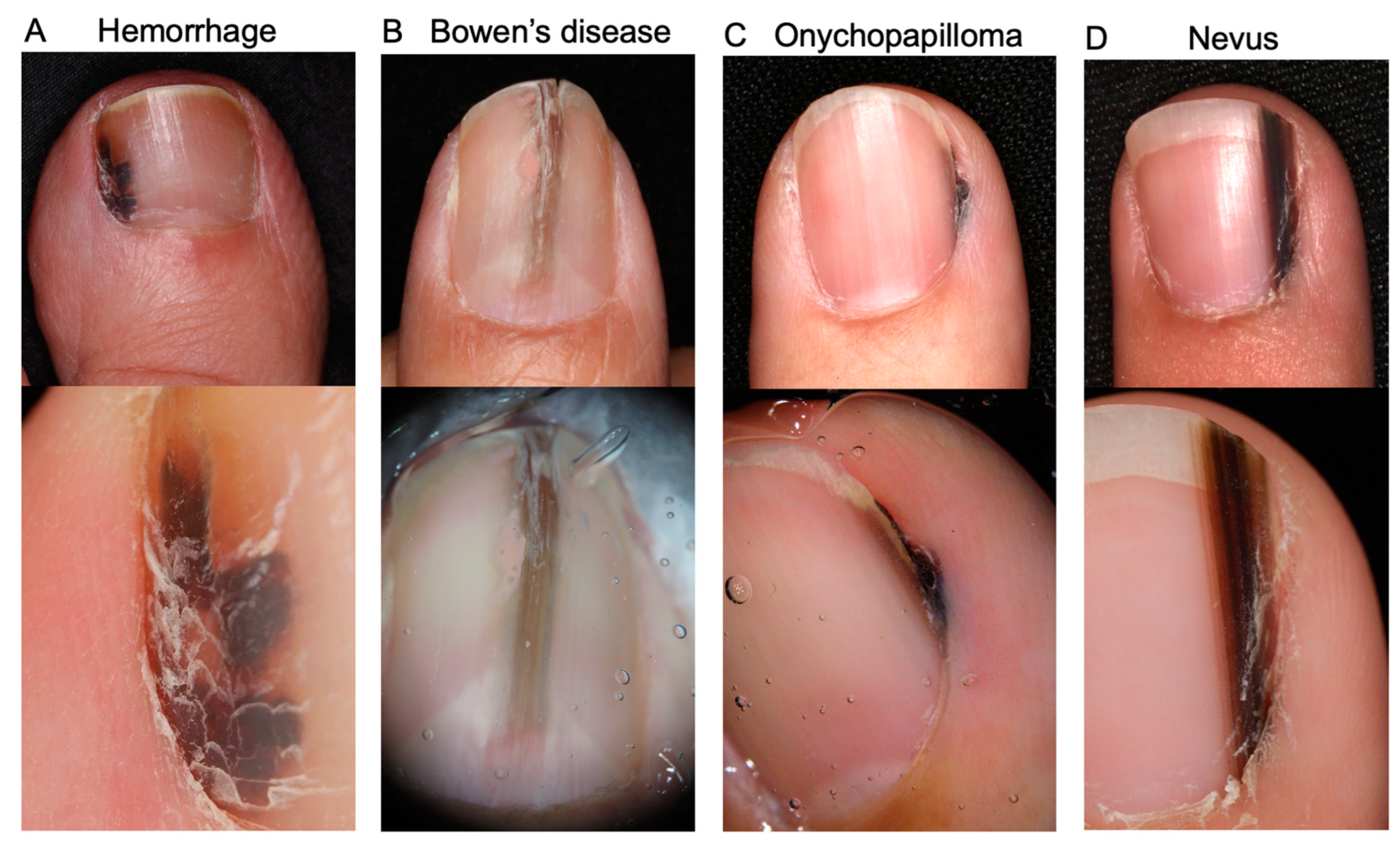 Melanoma Cancer Under Fingernail