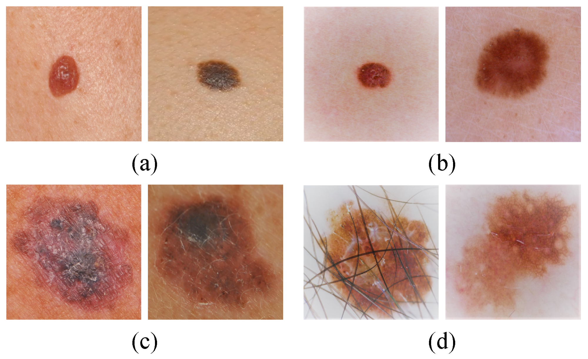 Melanoma Early Stages