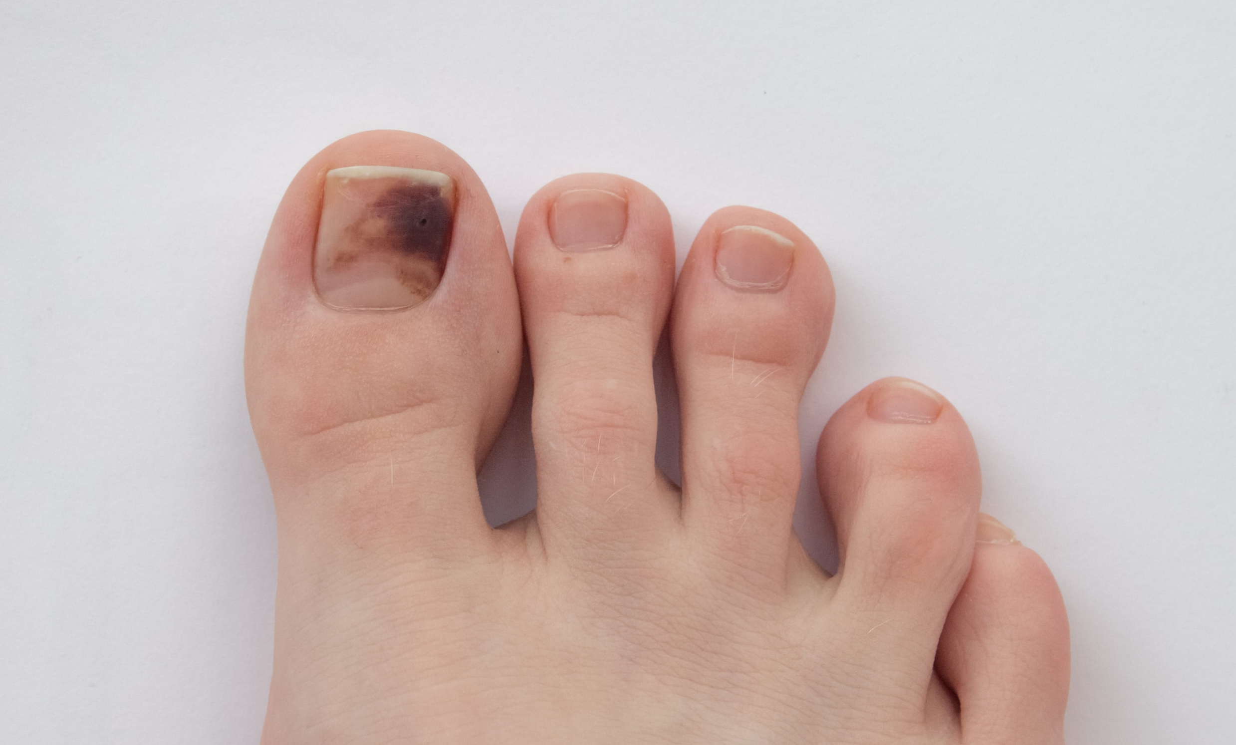 Melanoma Skin Cancer Toenail