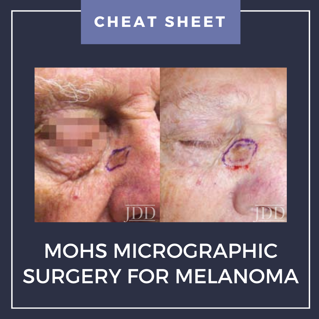 Melanoma Surgery On Face