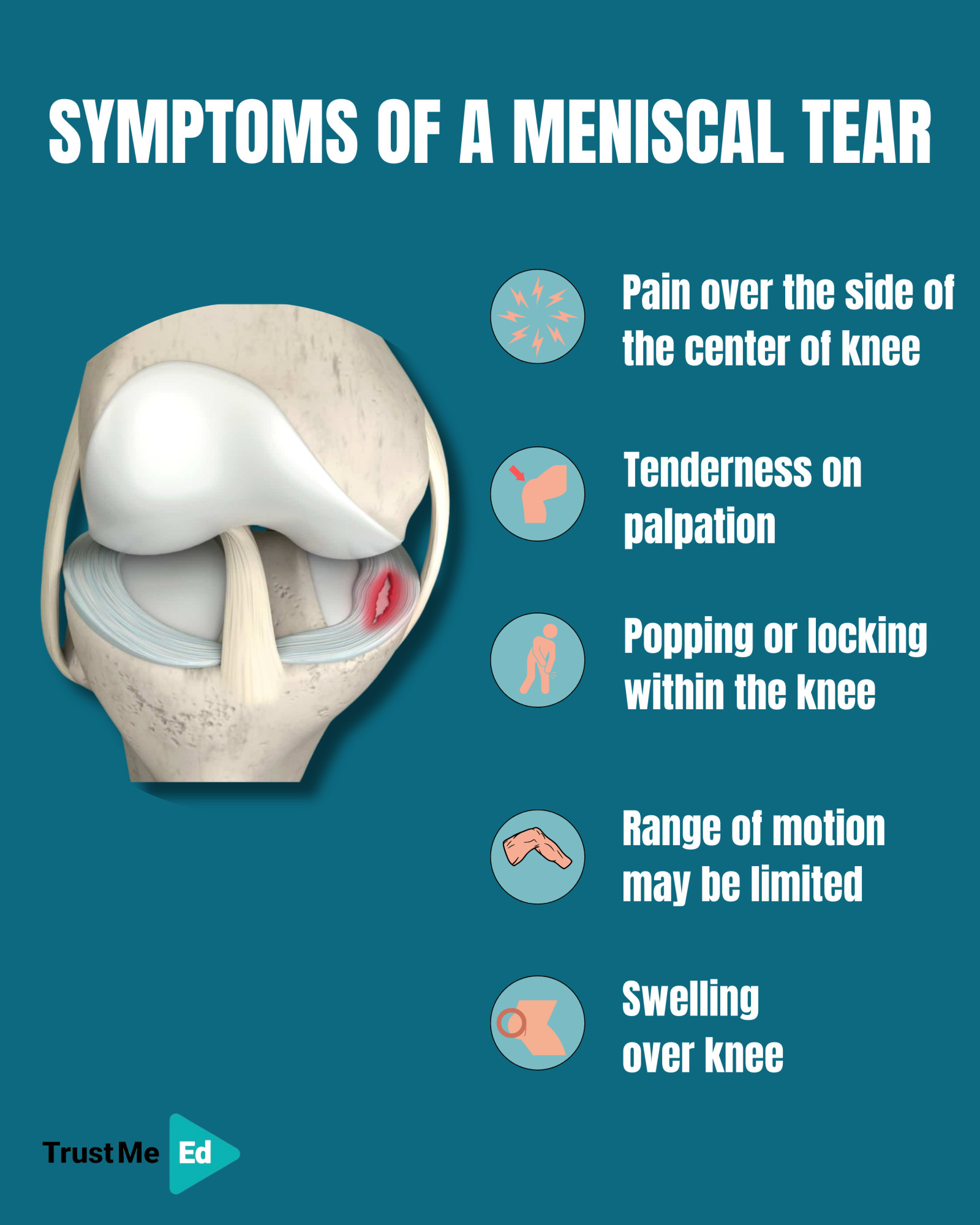 Meniscus Injury Symptoms