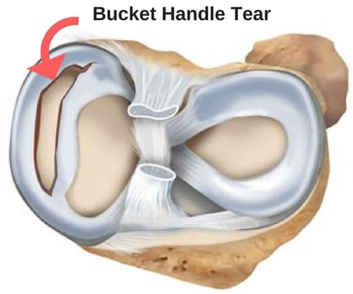 Meniscus Tear Knee