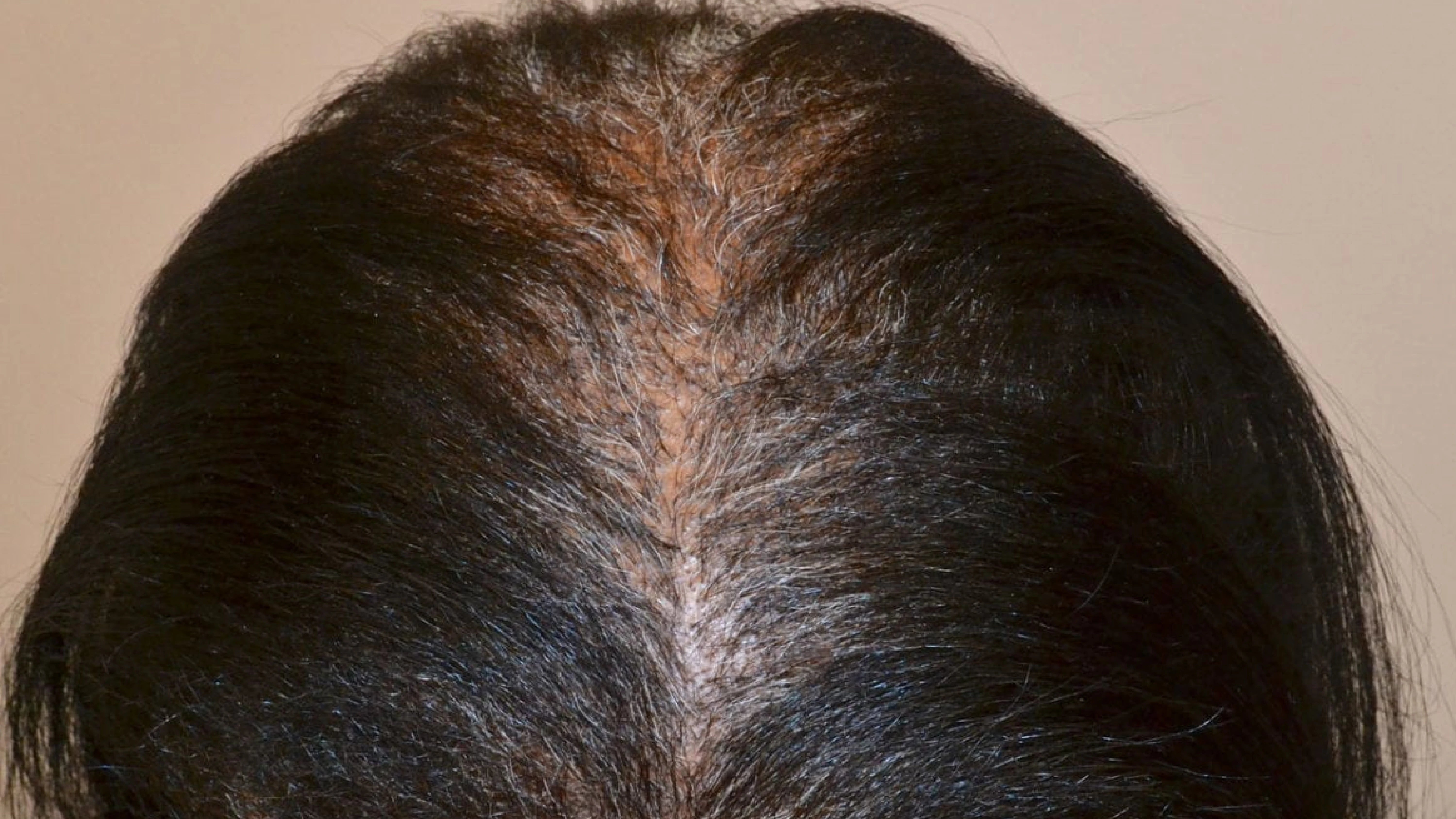 Menopause Hair Loss Treatment