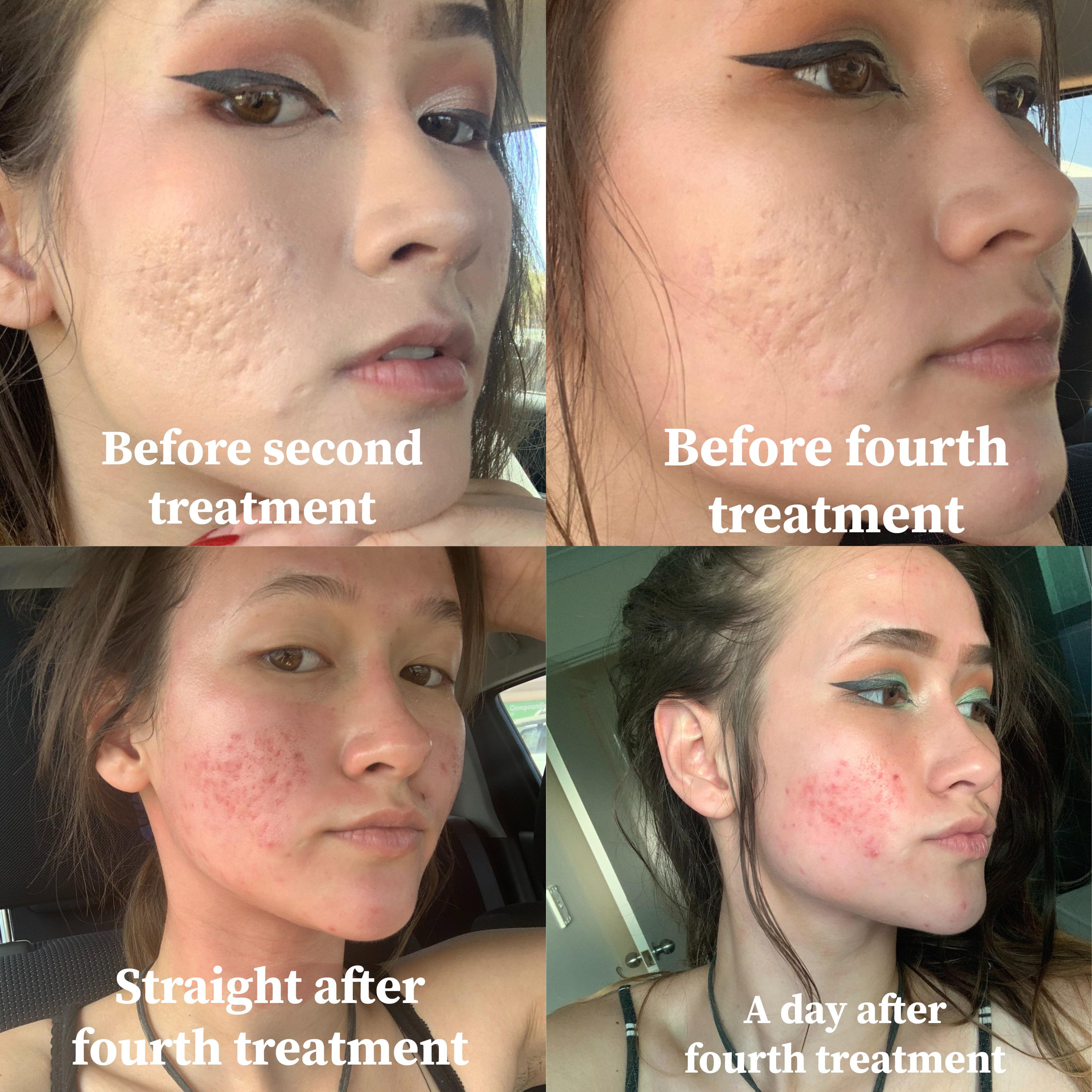 Micro Needling Before And After