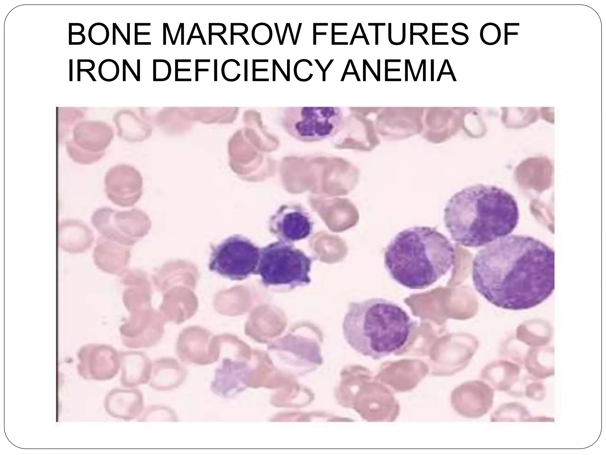 Microcytic Hypochromic Anemia