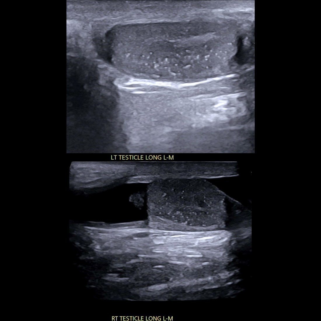 Microlithiasis In Testis