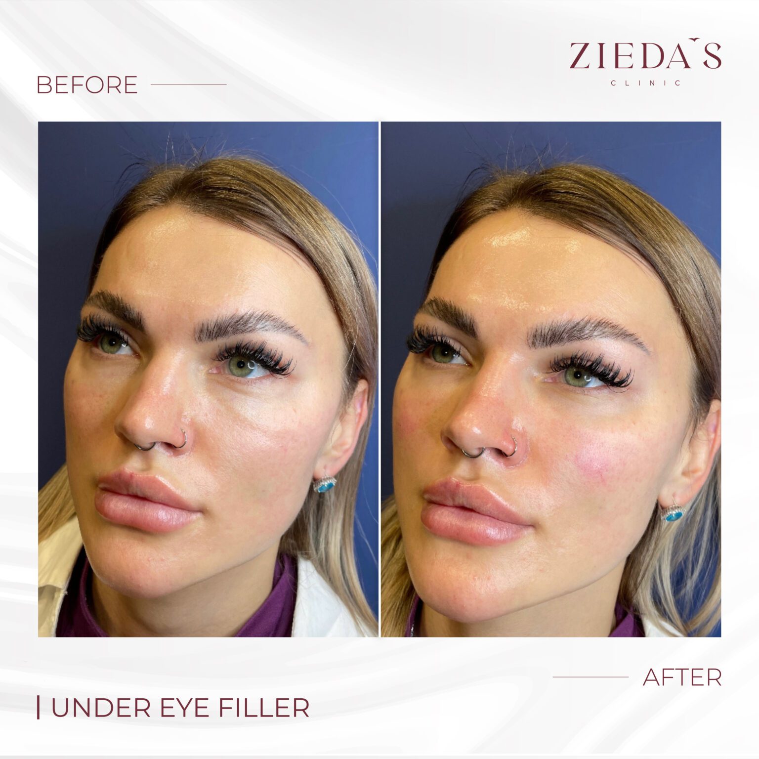 Migration Of Under Eye Filler