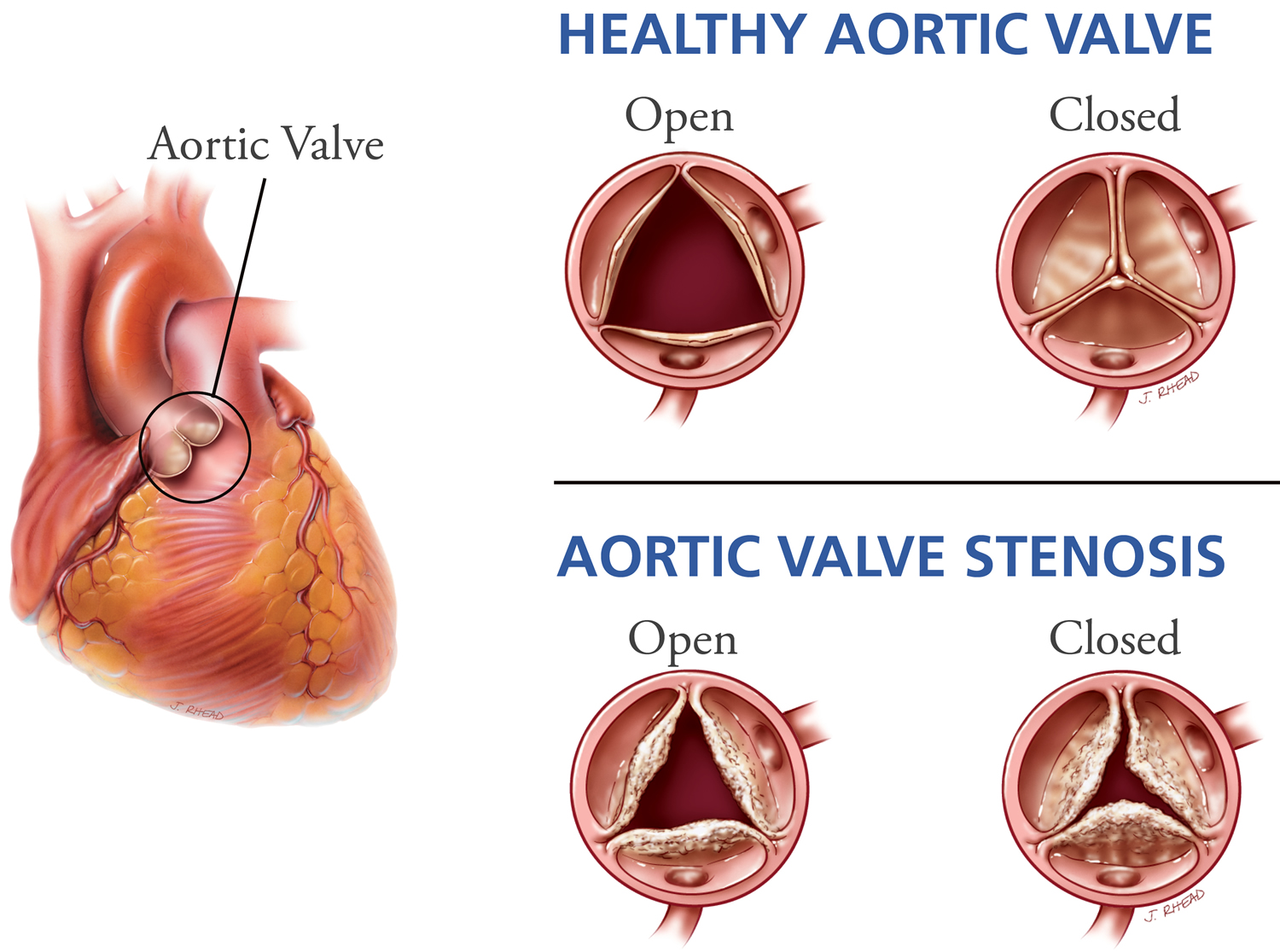 Mild Aortic Stenosis