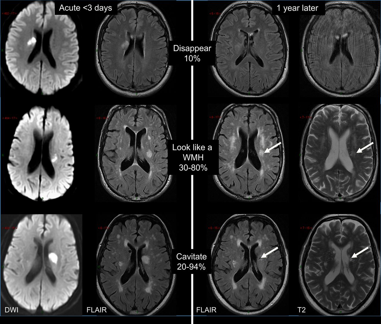 Mild Chronic Microvascular Ischemic Changes