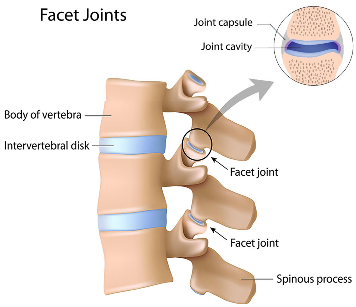 Mild Facet Arthropathy