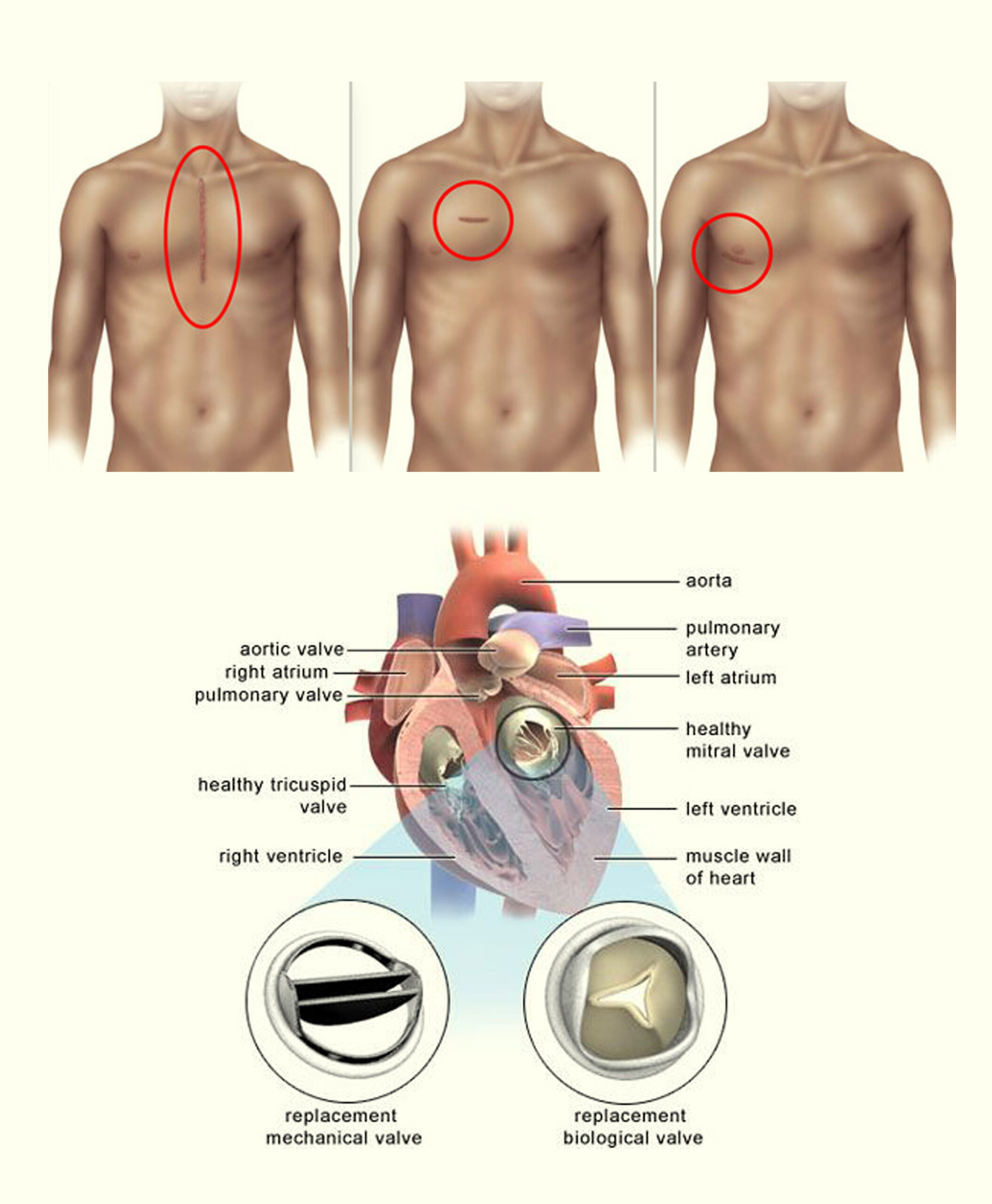 Mitral Replacement Valve