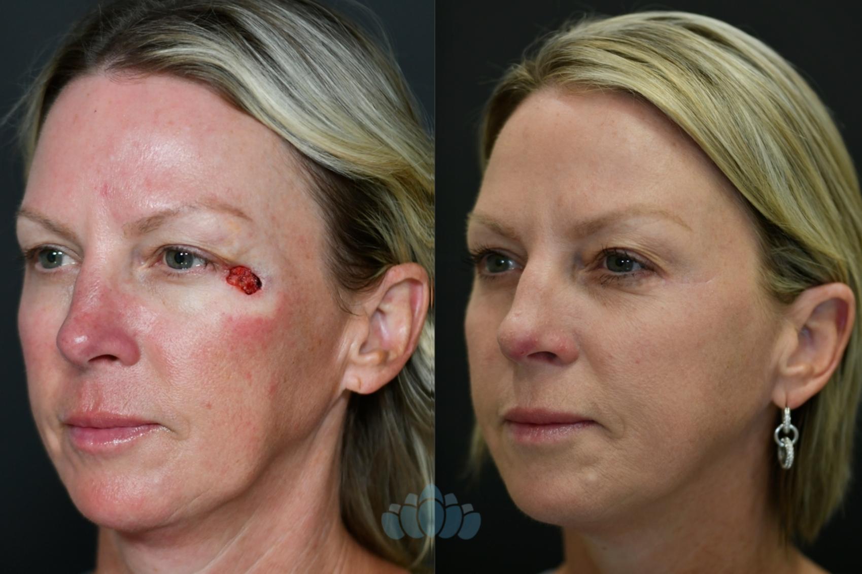 Mohs Surgery For Skin Cancer On Face