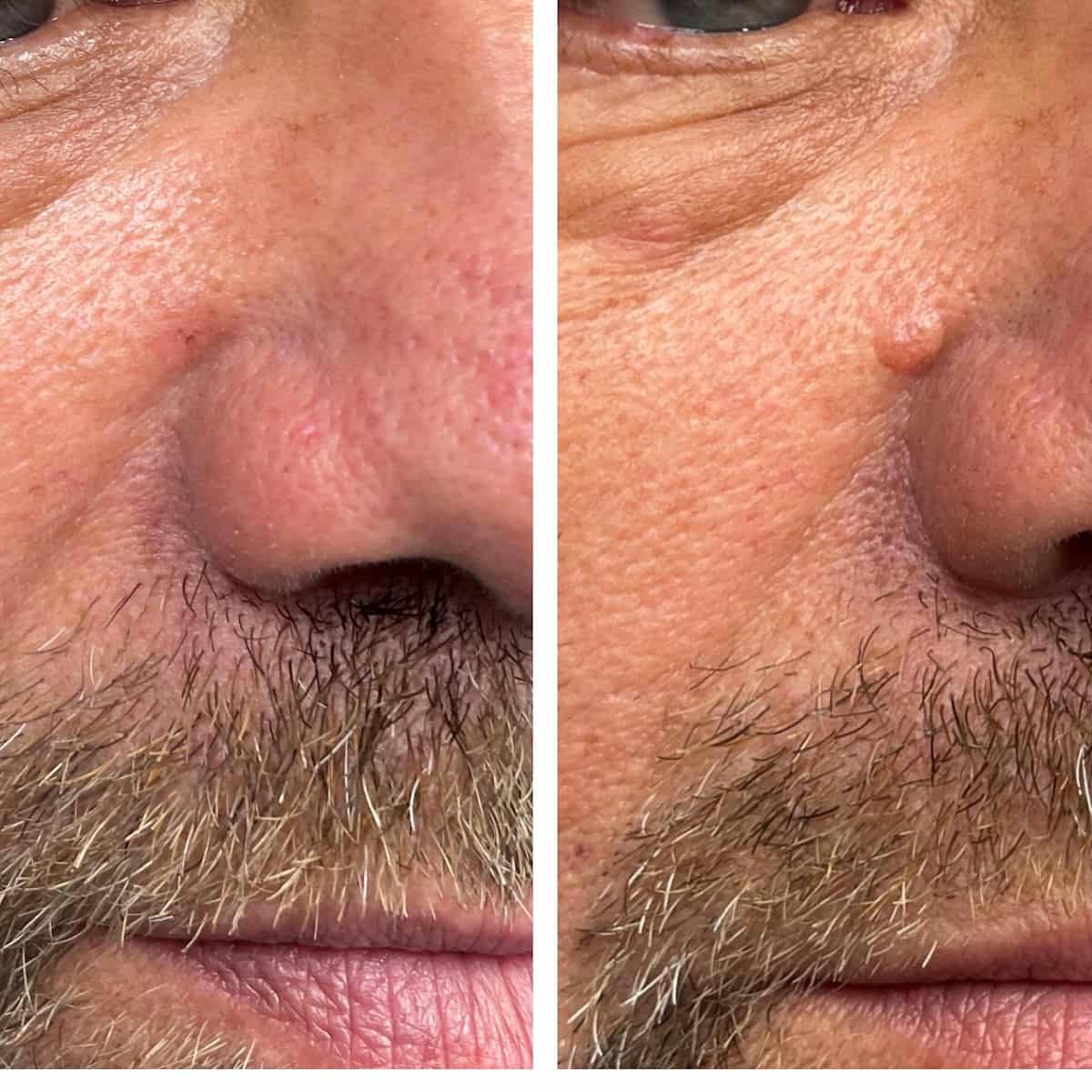 Mole Removal On Face
