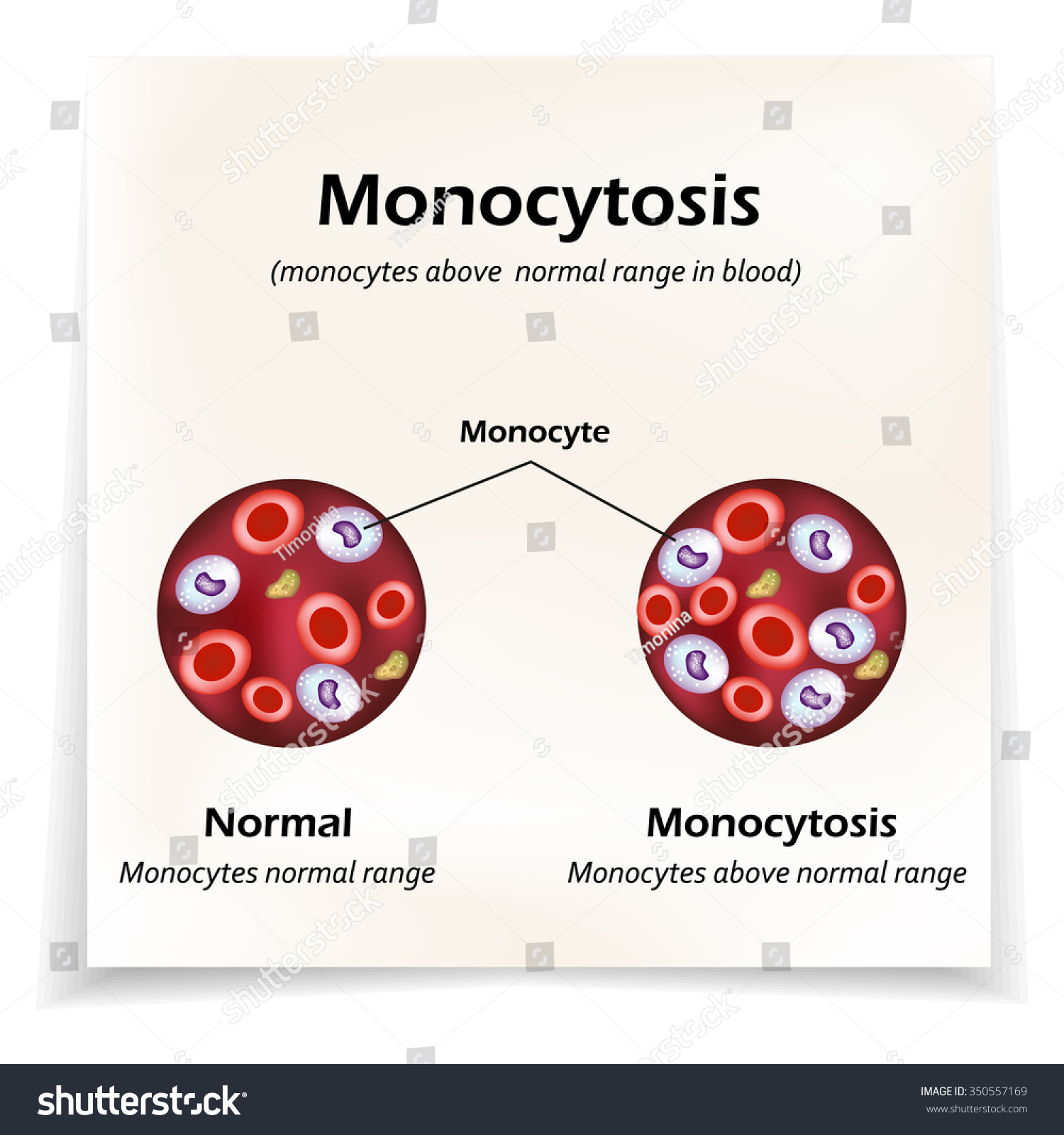 Monocytes Normal Range