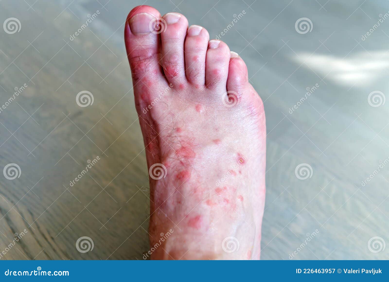 Mosquito Bites On Feet
