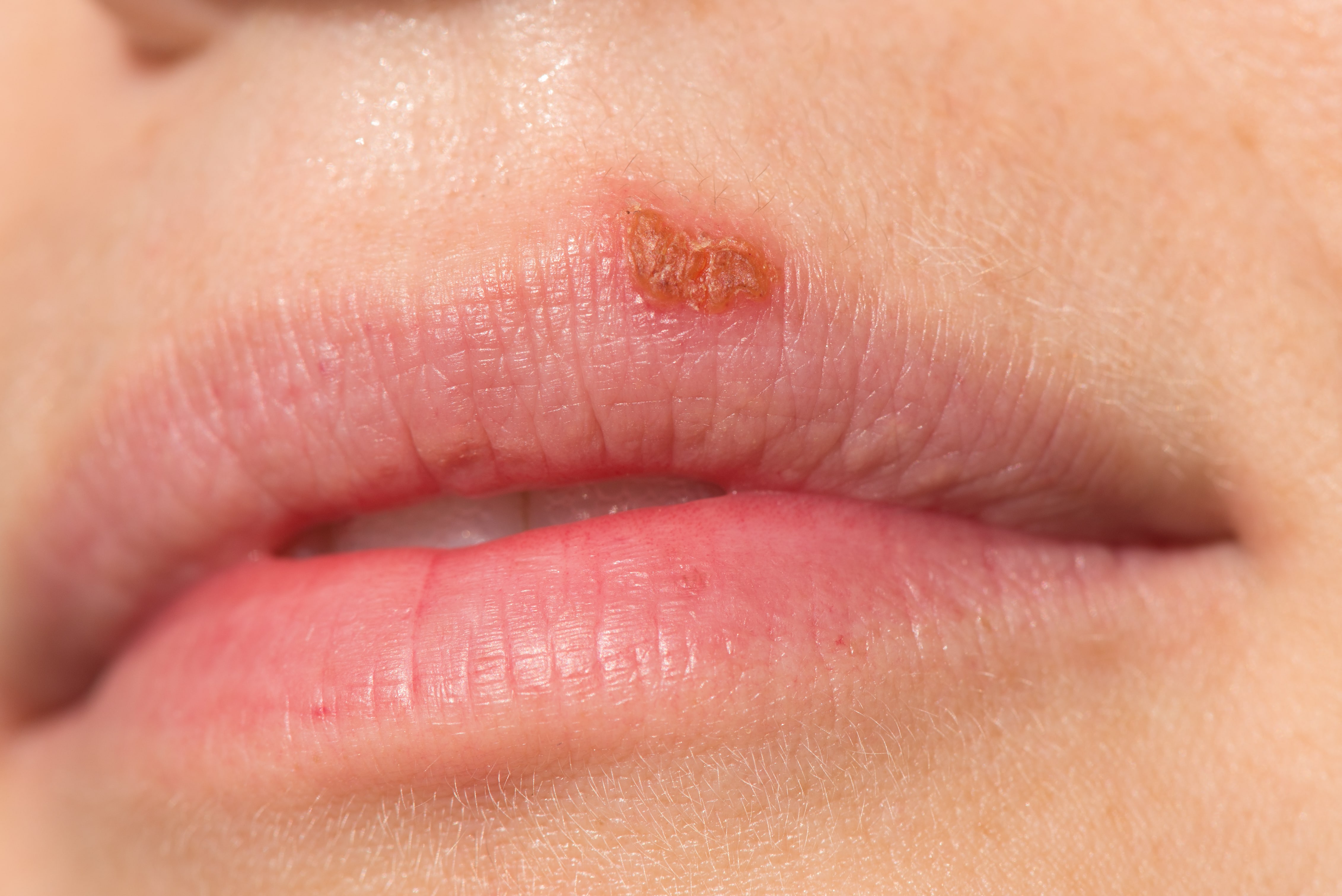 Mouth Herpes Or Pimple