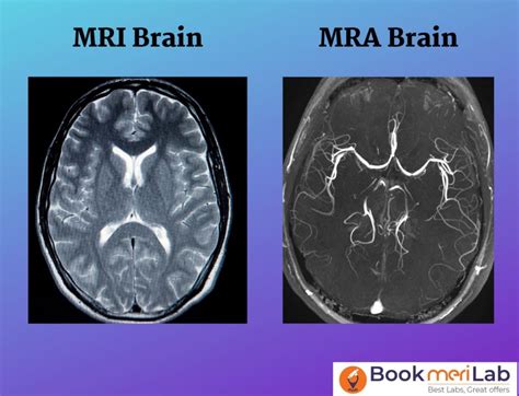 Mra Vs Mri