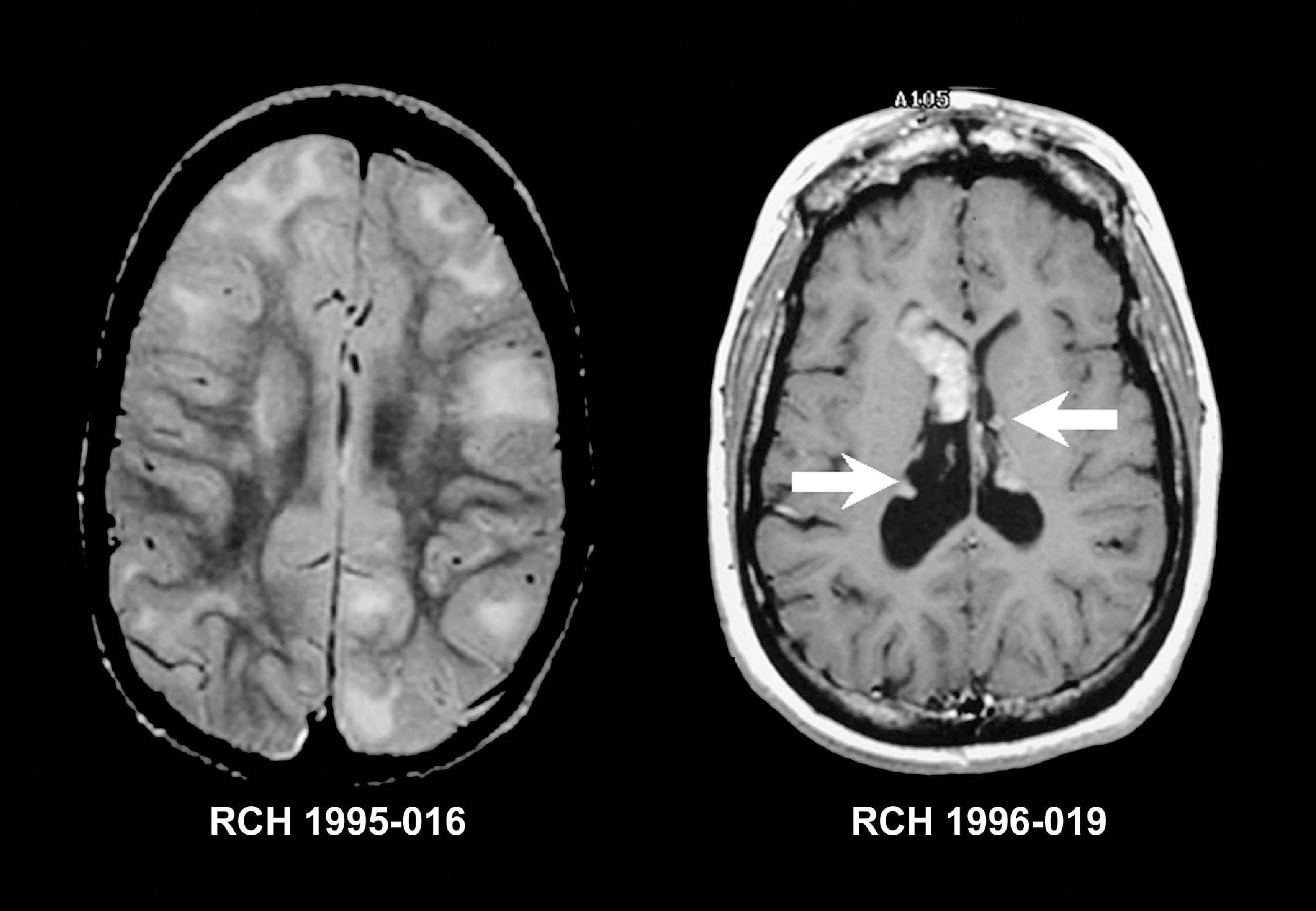 Mri Brain W Wo Contrast