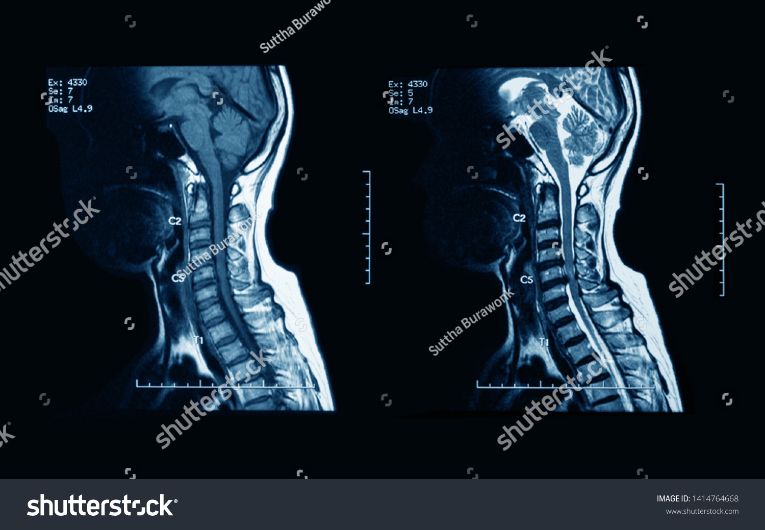 Mri Cervical Spine Without Contrast