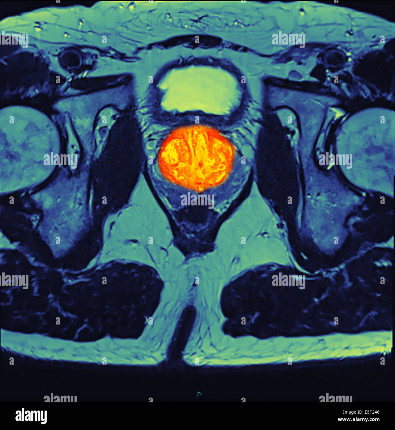Mri For Prostate Cancer