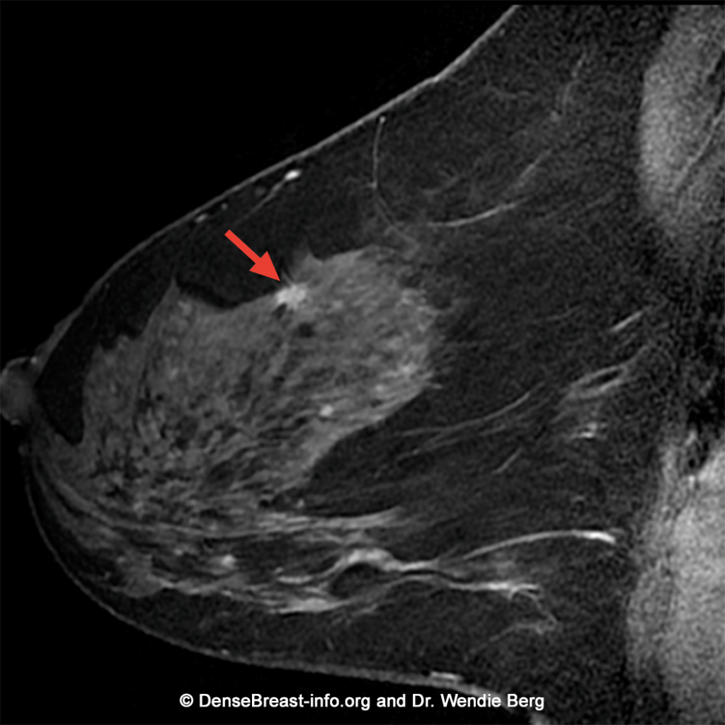 Mri Of Breasts