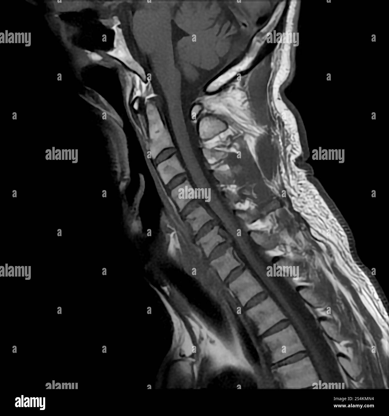Mri Of Cervical Spine