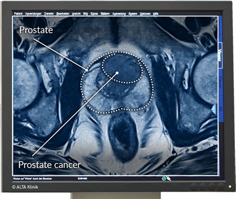 Mri Of Prostate