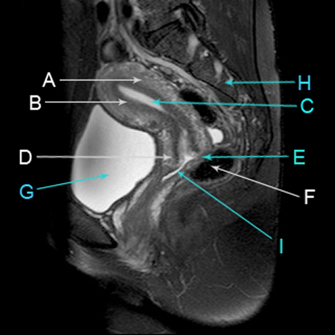 Mri Pelvis Without Contrast