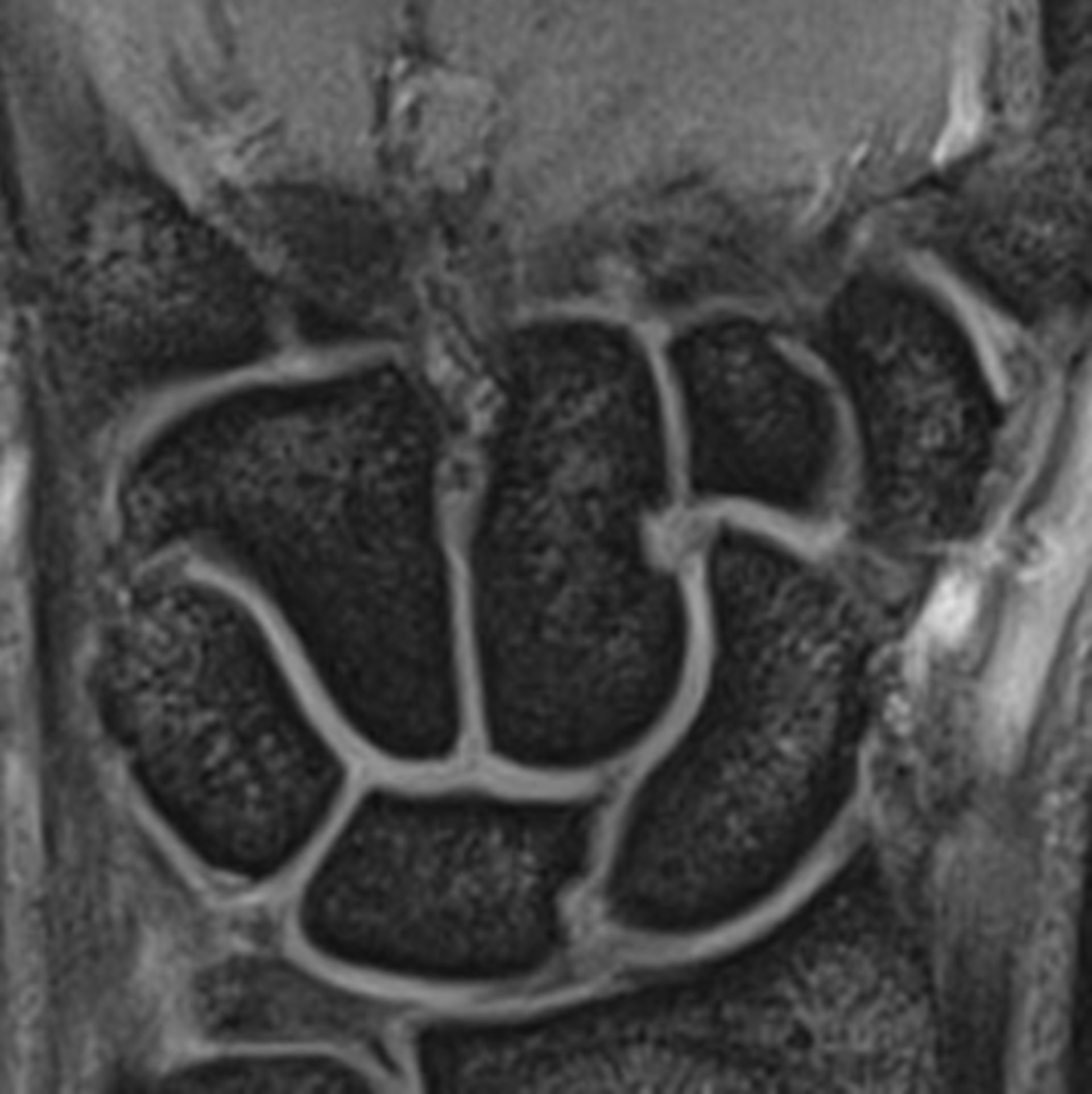 Mri Wrist Joint