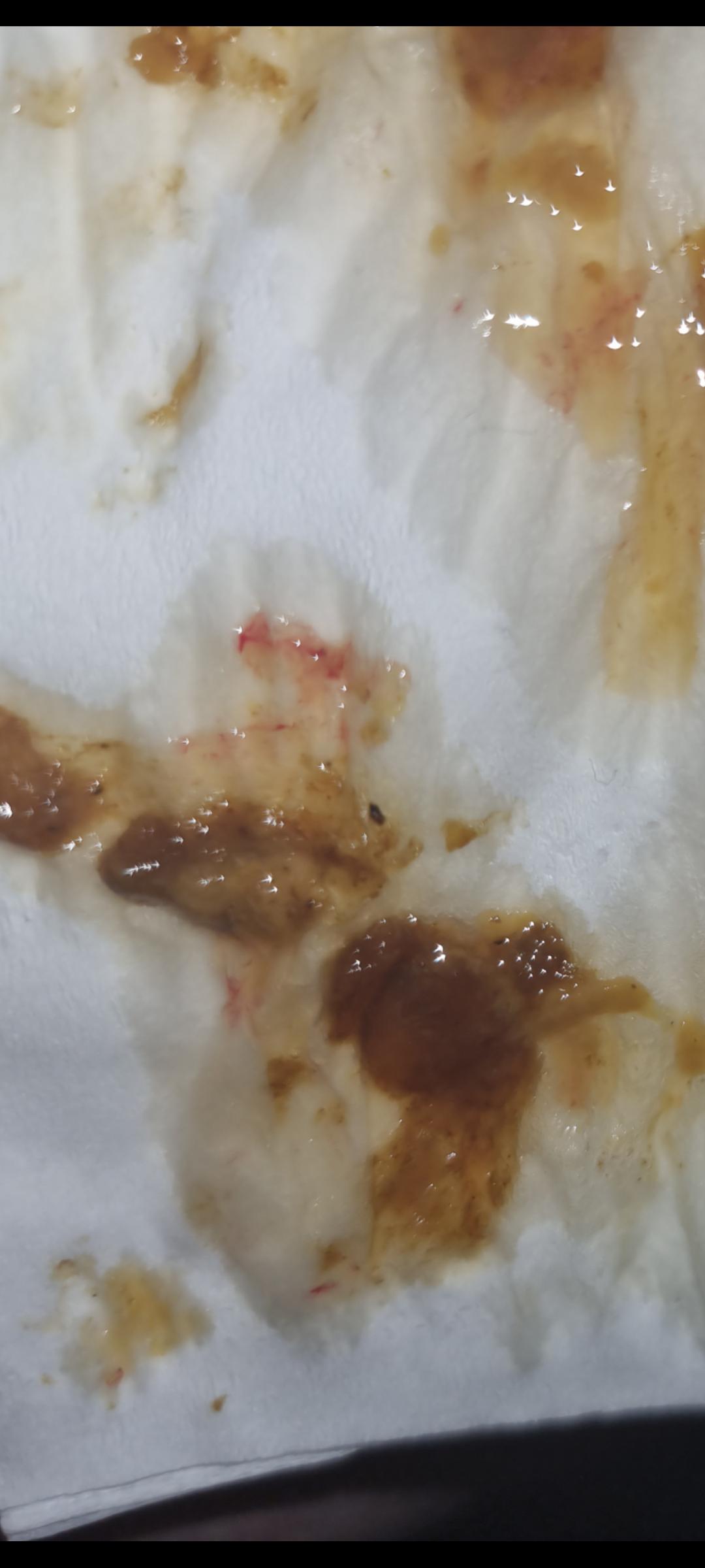 Mucoid Stool With Blood