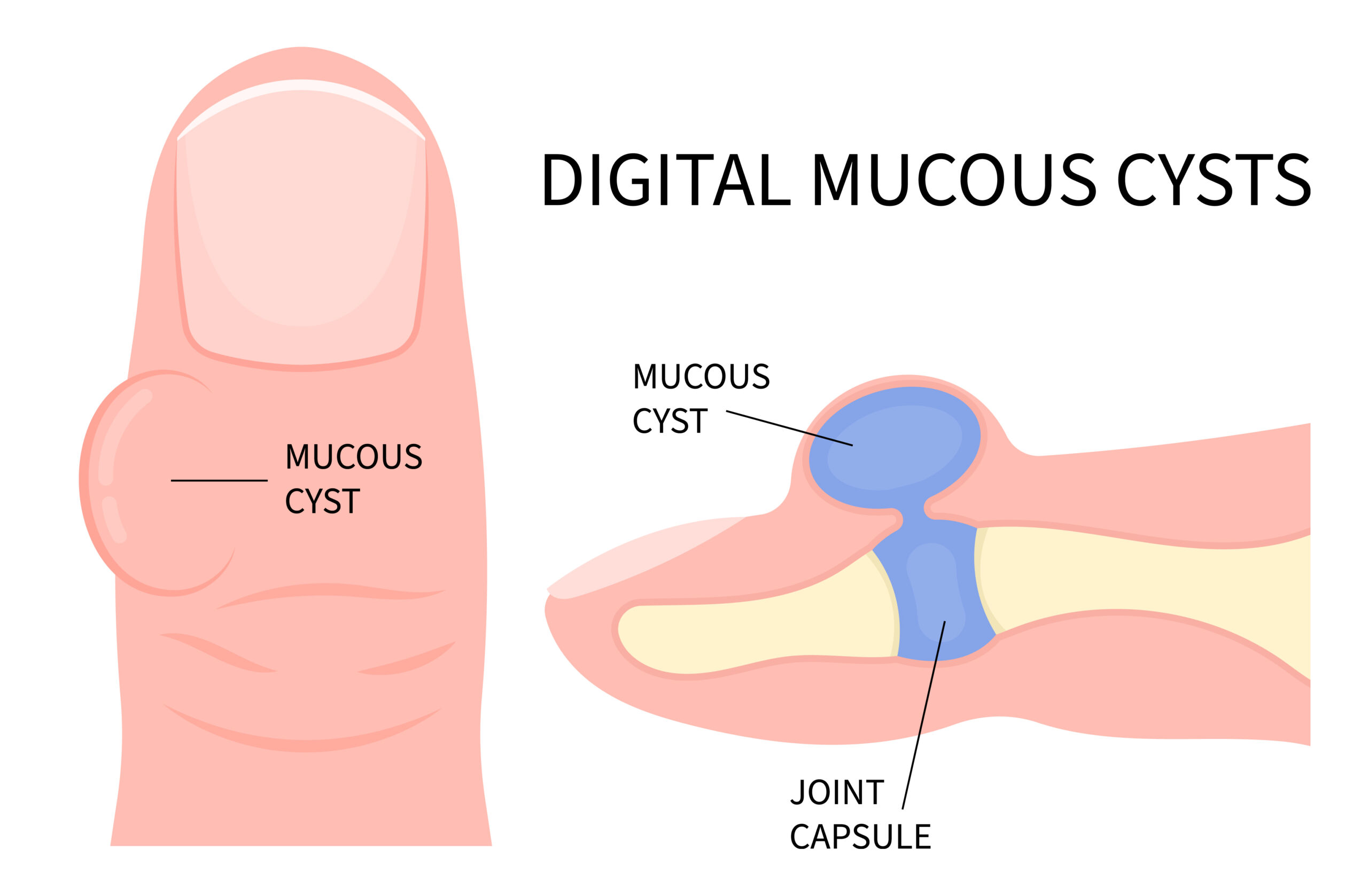 Mucous Cyst Finger