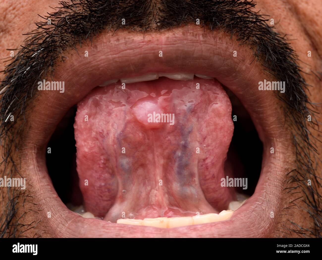 Mucous Retention Cyst