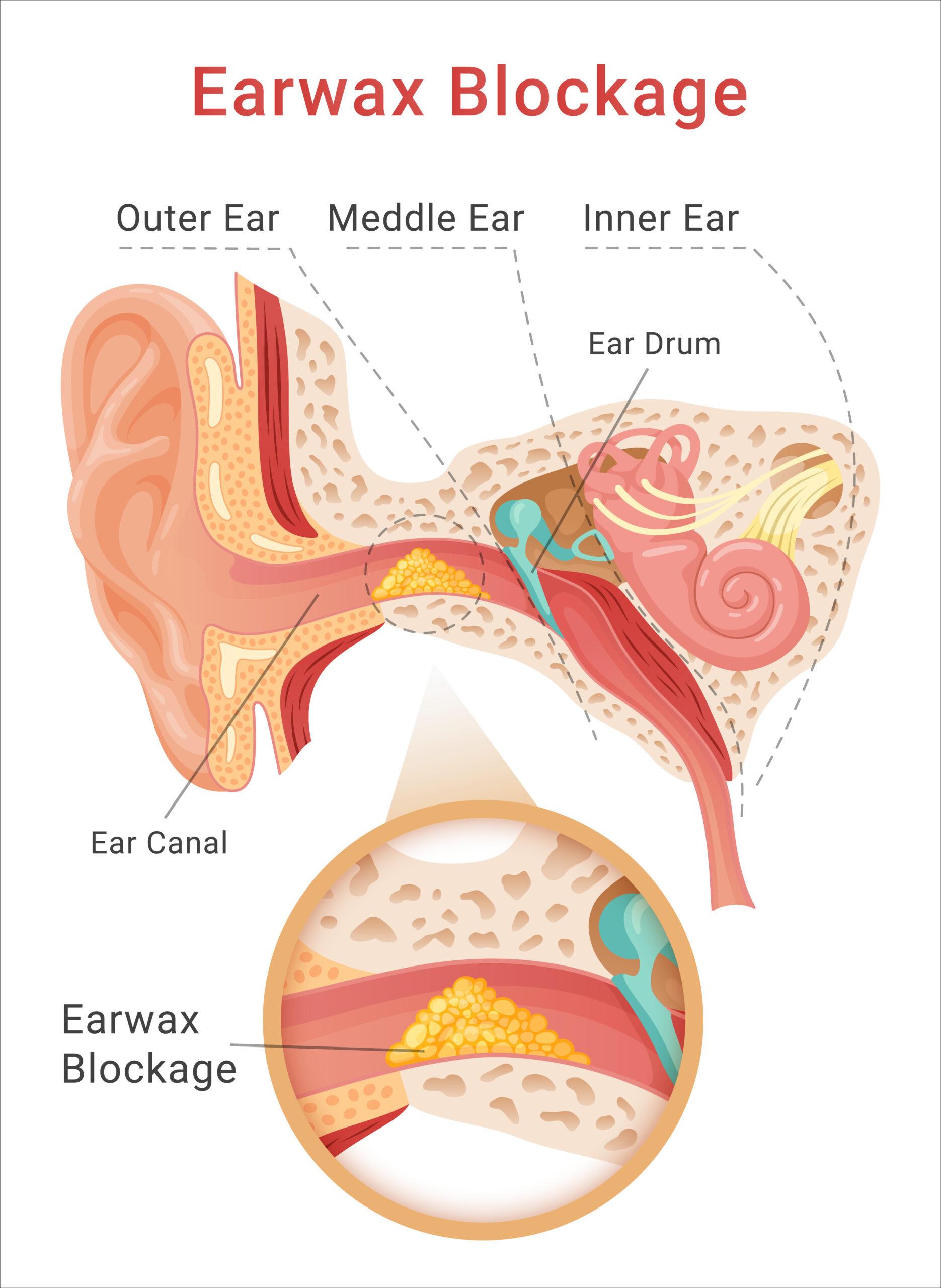 My Ear Is Clogged