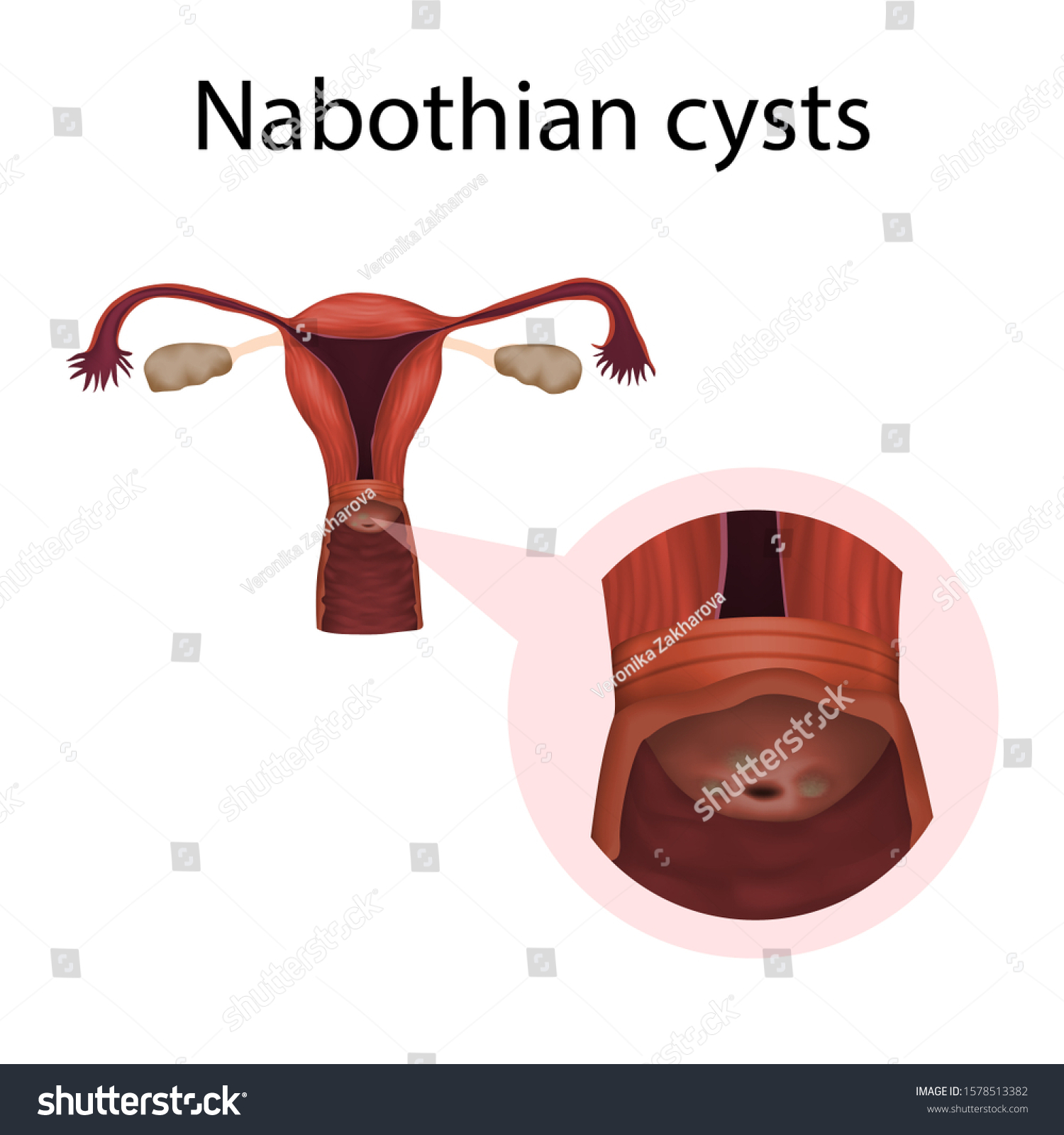 Nabothian Cysts In The Cervix