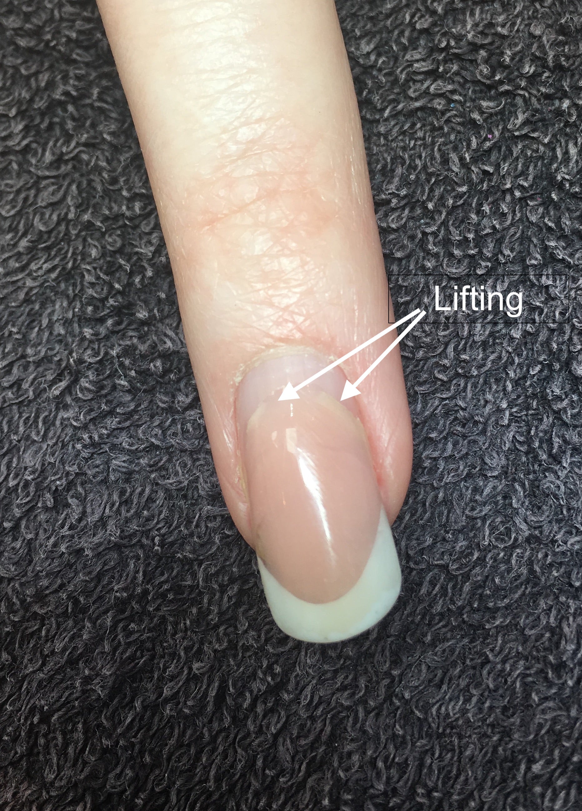 Nail Lifting From Nail Bed