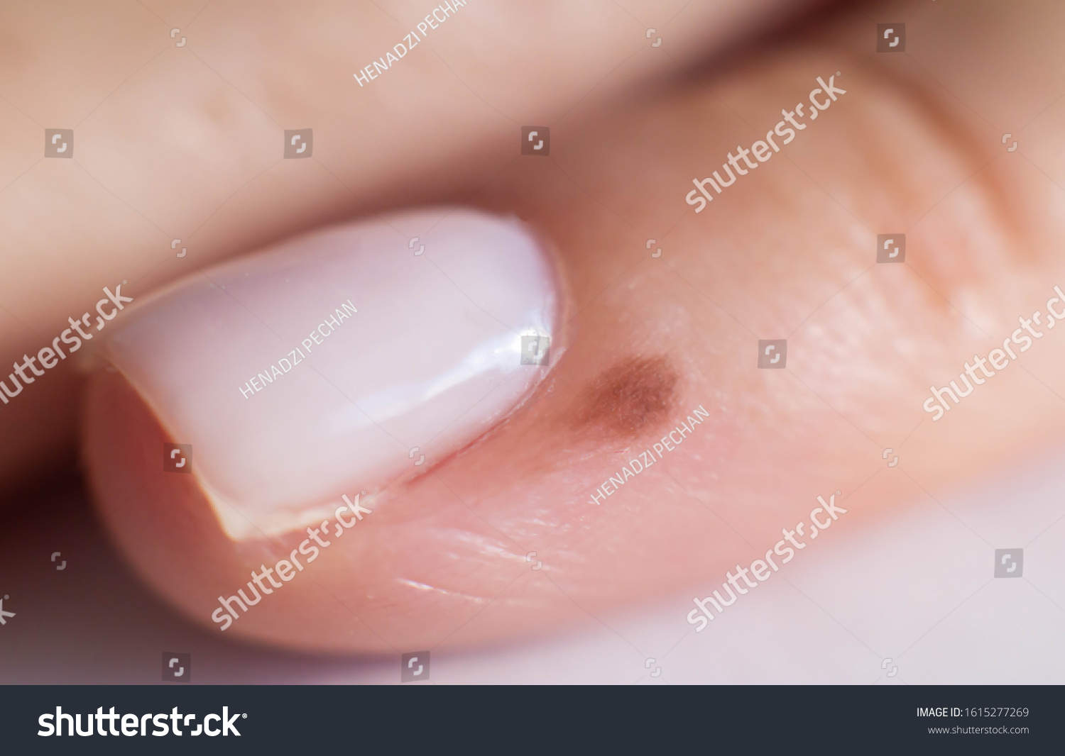 Nail Melanoma Images