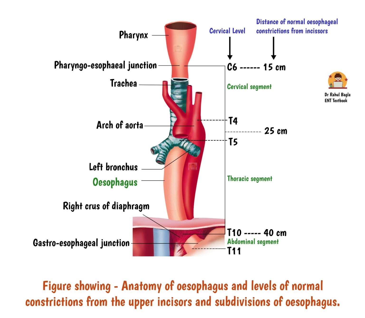 Narrowing Of The Esophagus